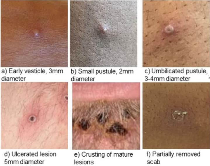 viruela simica lesiones