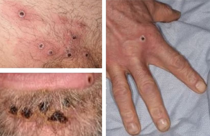 viruela simica lesiones